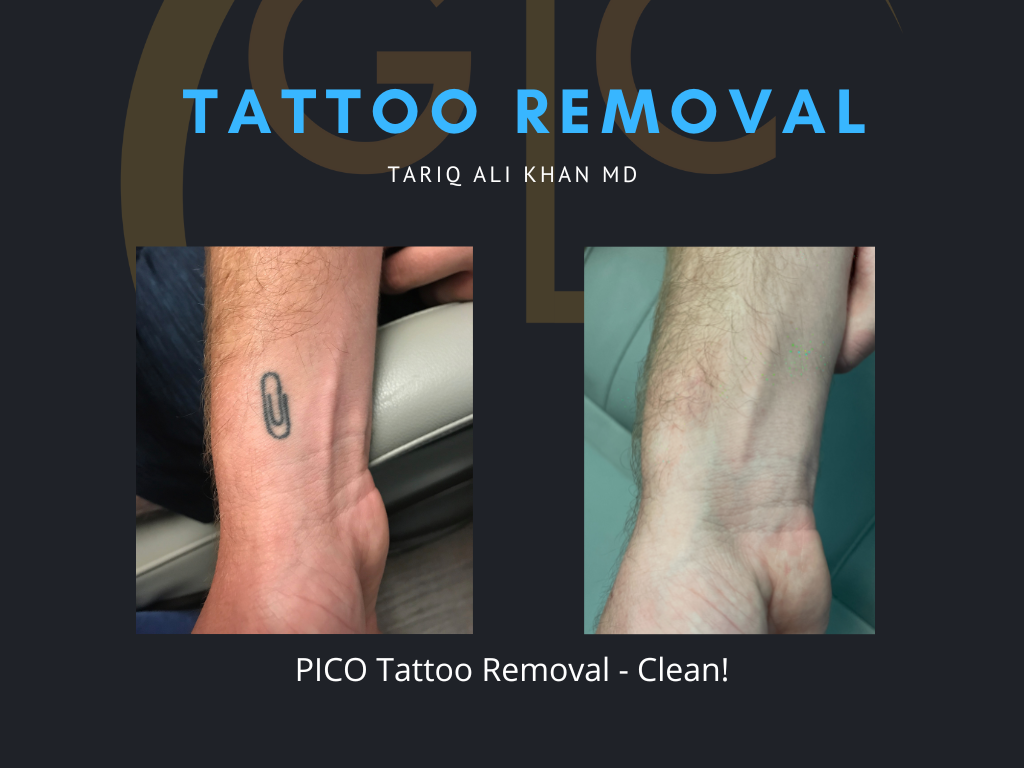 Gentle Care Laser Tustin Before and After picture - Tattoo Removal Mucosal Surface